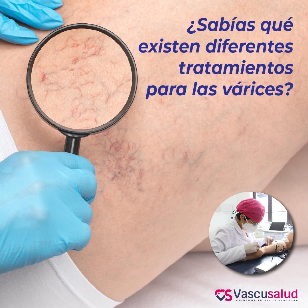 ¿Cómo lograr resultados visibles y duraderos en el tratamiento de varices?