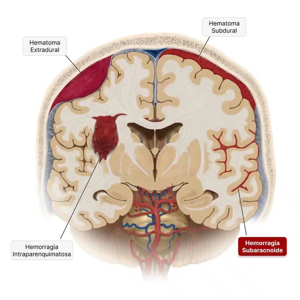 Tenía derrames en el cerebro y el corazón y edema en los pulmones.  Según el resumen, los dos grupos de amigos tuvieron un roce en el pub