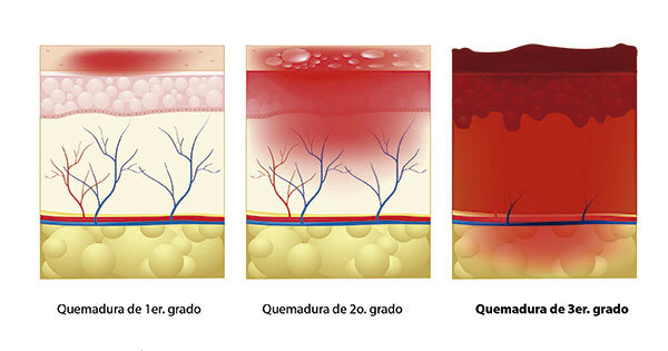 Tenía quemaduras de tercer grado que cubrían el 80% de su cuerpo y falleció veinte horas después de ser ingresado en la unidad de quemados de Chuac.