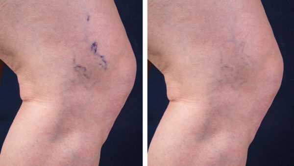 tratamiento para varices