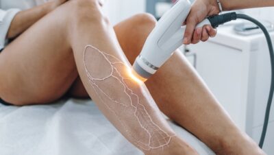 eliminar varices sin cirugía precios