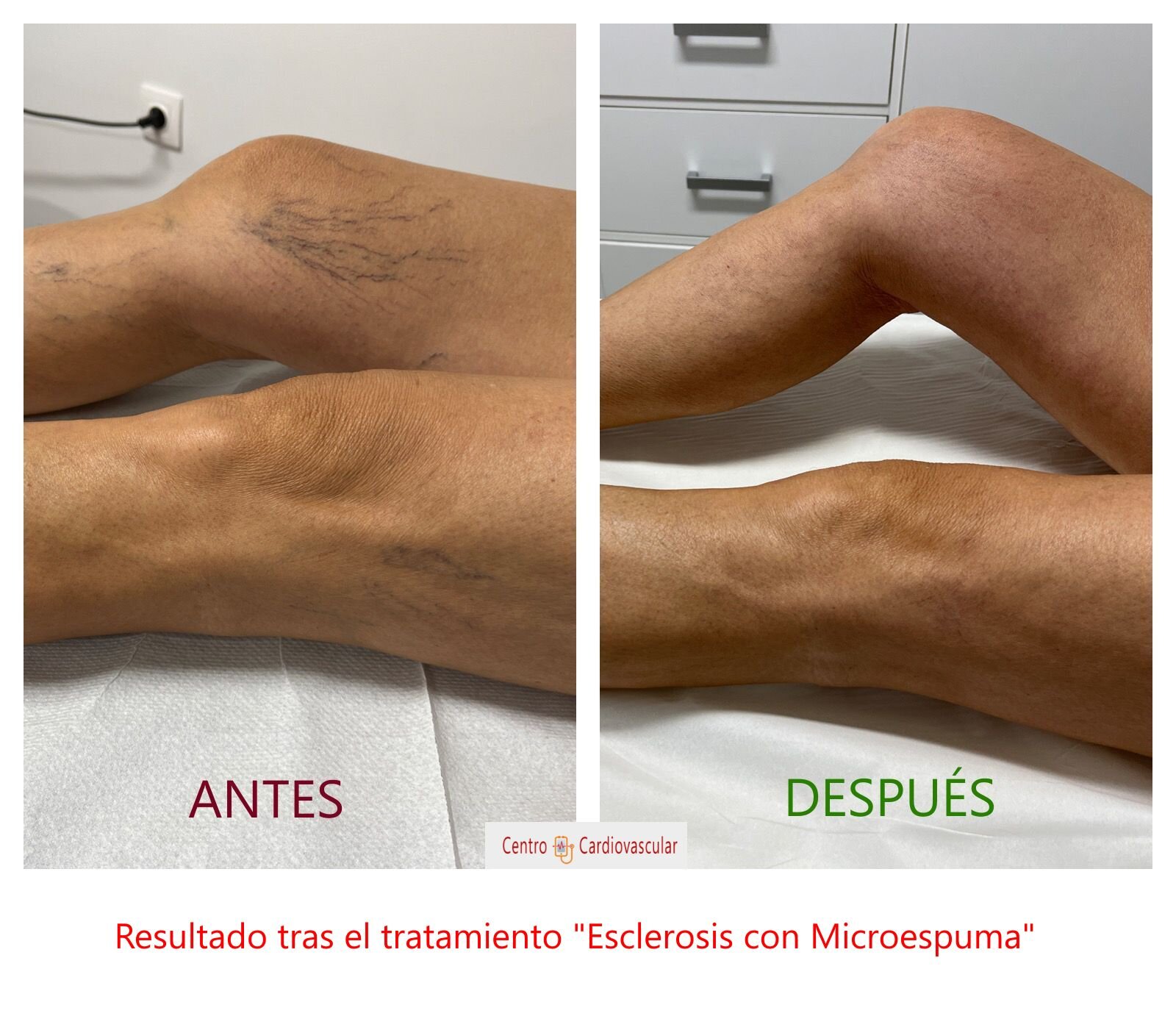 Tratamientos avanzados para eliminar varices sin cirugía