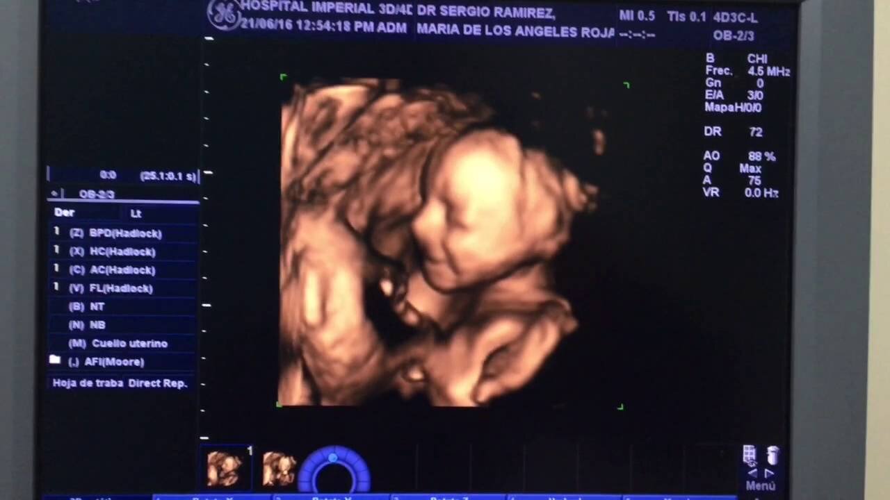 ultrasonido 4D
